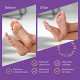 Aesta 3-in-1 Foot Peel Mask Set – Exfoliating Foot Mask with Moisturizer & Cleanser for Dry, Cracked Heels & Callus Removal – Plant-Based, Vegan, Men & Women
