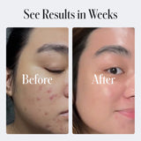 Acne Control Body Wash